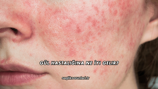 Gül Hastalığına Ne İyi Gelir?