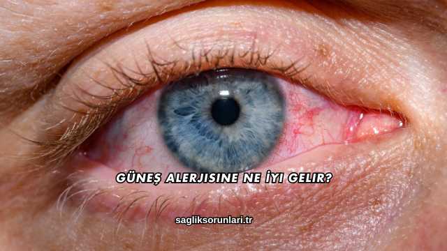 Güneş Alerjisine Ne İyi Gelir?