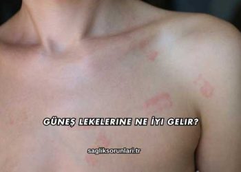 Güneş Lekelerine Ne İyi Gelir?