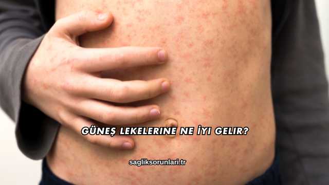 Güneş Lekelerine Ne İyi Gelir?