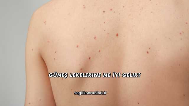 Güneş Lekelerine Ne İyi Gelir?