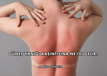 Güneş Yanığı Kaşıntısına Ne İyi Gelir?
