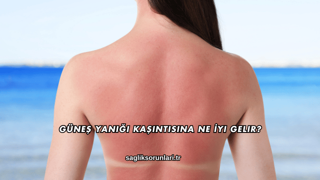 Güneş Yanığı Kaşıntısına Ne İyi Gelir?