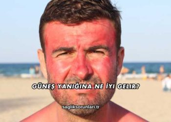 Güneş Yanığına Ne İyi Gelir?