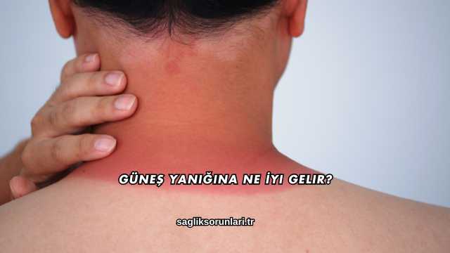 Güneş Yanığına Ne İyi Gelir?