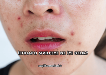 İltihaplı Sivilceye Ne İyi Gelir?