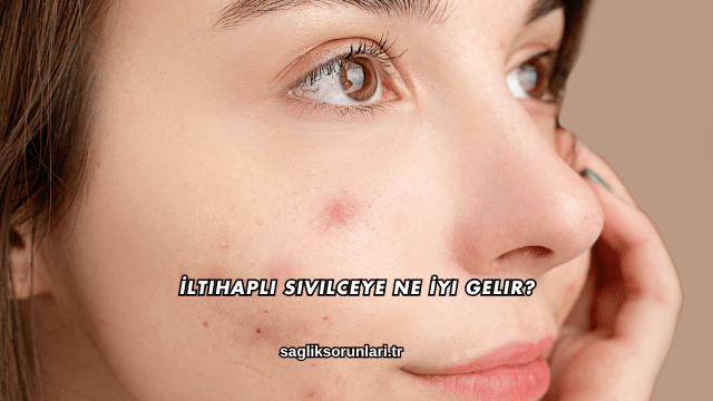 İltihaplı Sivilceye Ne İyi Gelir?