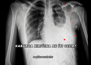 Kaburga Kırığına Ne İyi Gelir?