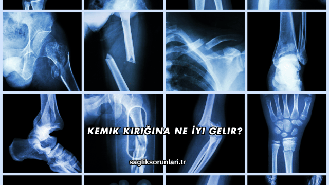 Kemik Kırığına Ne İyi Gelir?