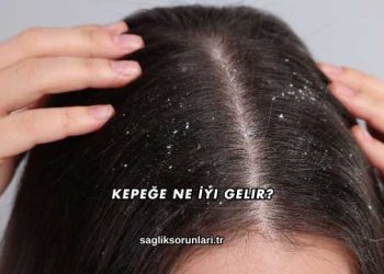 Kepeğe Ne İyi Gelir?