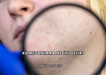 Komedonlara Ne İyi Gelir?