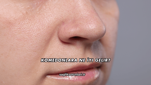 Komedonlara Ne İyi Gelir?