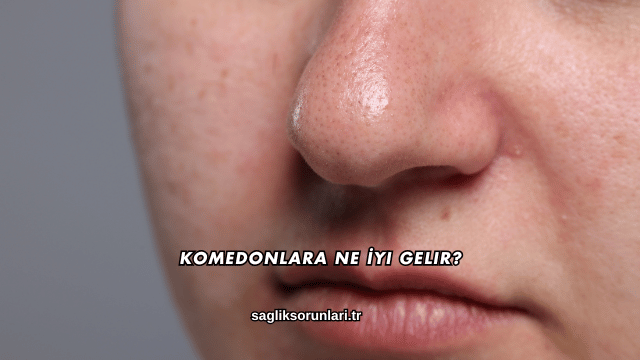 Komedonlara Ne İyi Gelir?