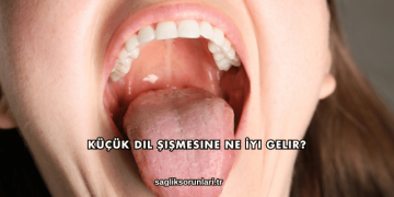 Küçük Dil Şişmesine Ne İyi Gelir?