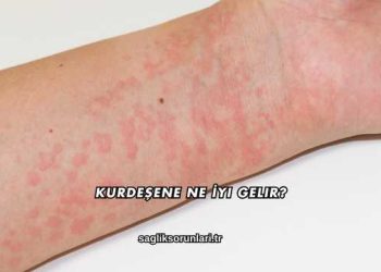 Kurdeşene Ne İyi Gelir?