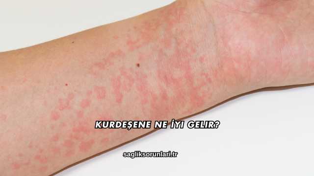 Kurdeşene Ne İyi Gelir?