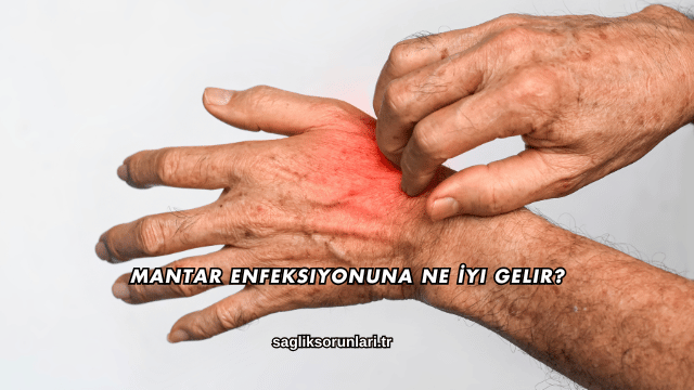Mantar Enfeksiyonuna Ne İyi Gelir?