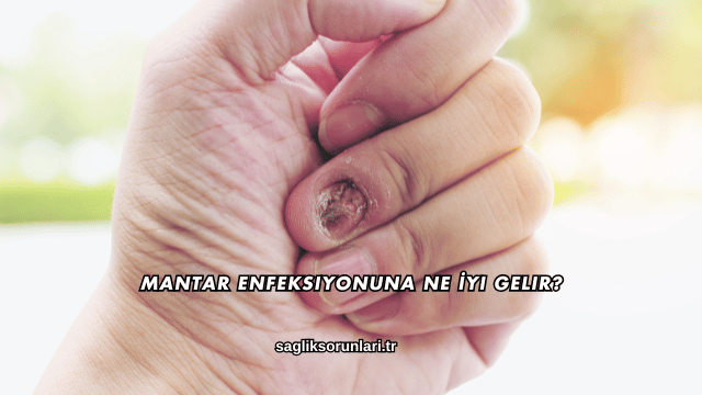 Mantar Enfeksiyonuna Ne İyi Gelir?