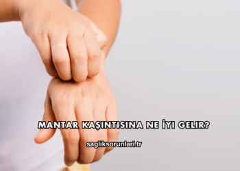 Mantar Kaşıntısına Ne İyi Gelir?
