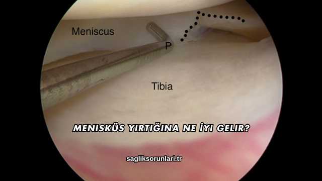 Menisküs Yırtığına Ne İyi Gelir?
