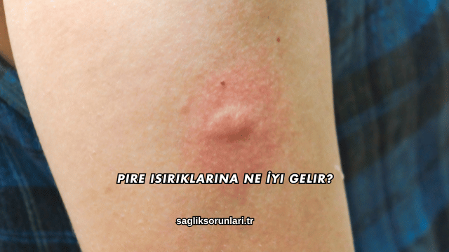 Pire Isırıklarına Ne İyi Gelir?