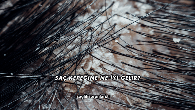 Saç Kepeğine Ne İyi Gelir?