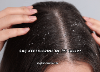 Saç Kepeklerine Ne İyi Gelir?