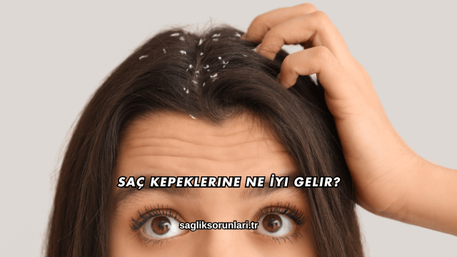 Saç Kepeklerine Ne İyi Gelir?