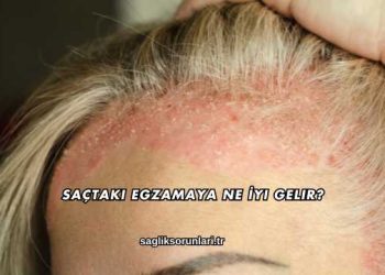 Saçtaki Egzamaya Ne İyi Gelir?