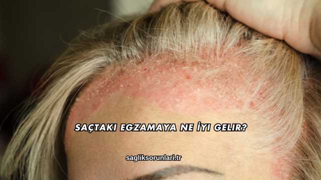 Saçtaki Egzamaya Ne İyi Gelir?