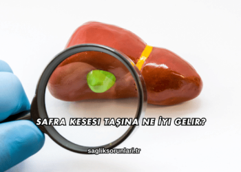 Safra Kesesi Taşına Ne İyi Gelir?