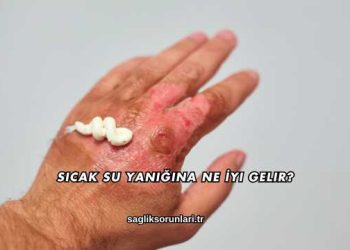 Sıcak Su Yanığına Ne İyi Gelir?