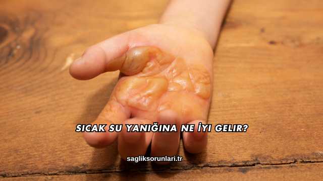 Sıcak Su Yanığına Ne İyi Gelir?