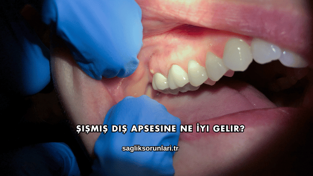 Şişmiş Diş Apsesine Ne İyi Gelir?