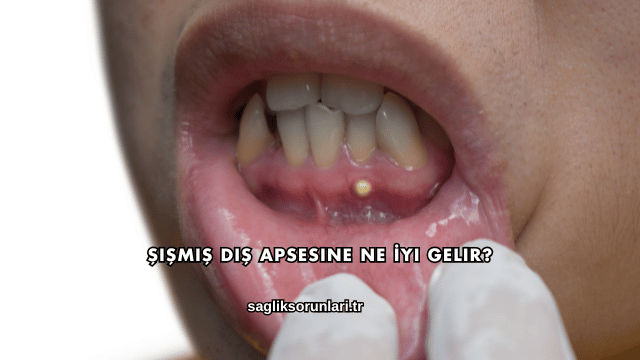 Şişmiş Diş Apsesine Ne İyi Gelir?