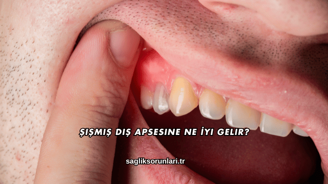 Şişmiş Diş Apsesine Ne İyi Gelir?