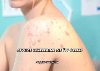 Sivilce Lekelerine Ne İyi Gelir?