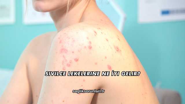 Sivilce Lekelerine Ne İyi Gelir?