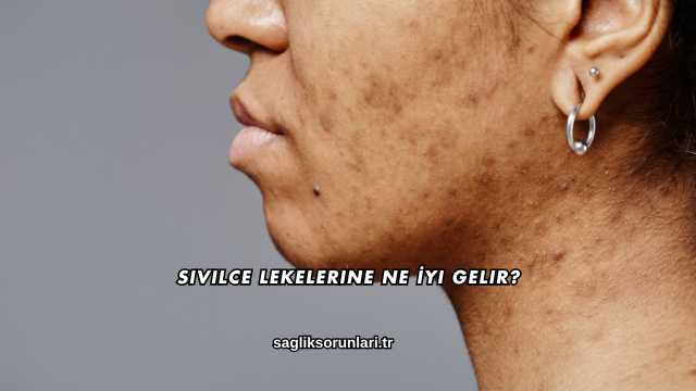 Sivilce Lekelerine Ne İyi Gelir?