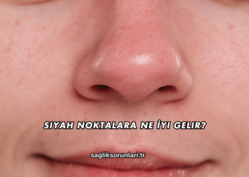 Siyah Noktalara Ne İyi Gelir?