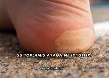 Su Toplamış Ayağa Ne İyi Gelir?