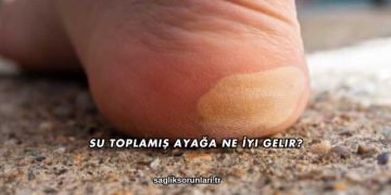 Su Toplamış Ayağa Ne İyi Gelir?