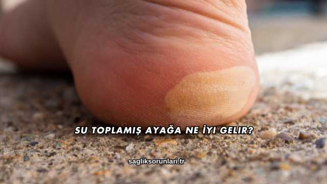 Su Toplamış Ayağa Ne İyi Gelir?