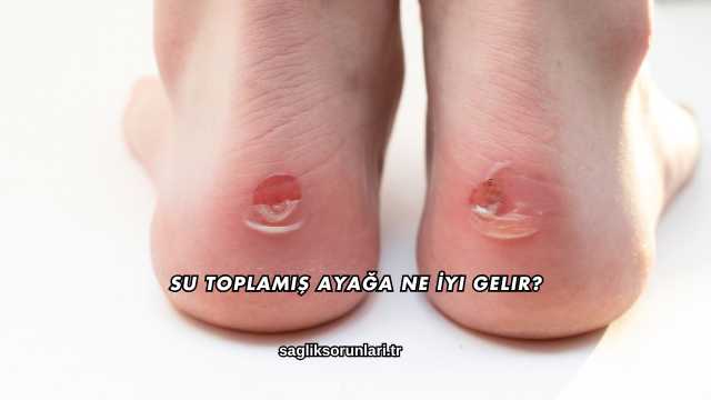 Su Toplamış Ayağa Ne İyi Gelir?