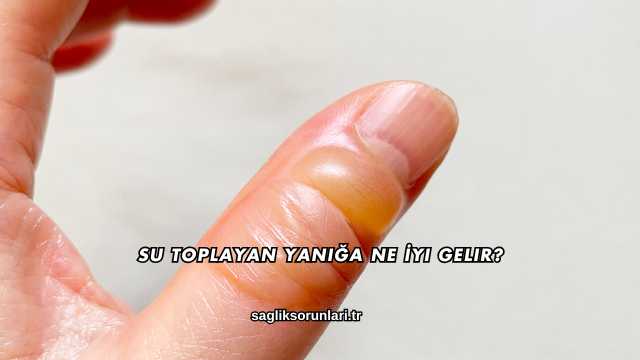Su Toplayan Yanığa Ne İyi Gelir?