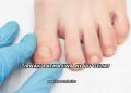 Tırnak Batmasına Ne İyi Gelir?