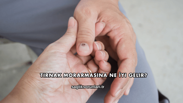 Tırnak Morarmasına Ne İyi Gelir?