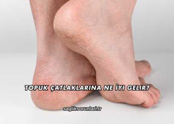 Topuk Çatlaklarına Ne İyi Gelir?