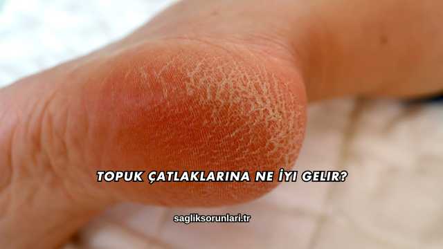 Topuk Çatlaklarına Ne İyi Gelir?