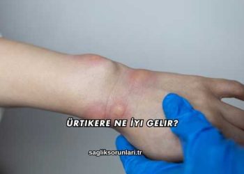 Ürtikere Ne İyi Gelir?